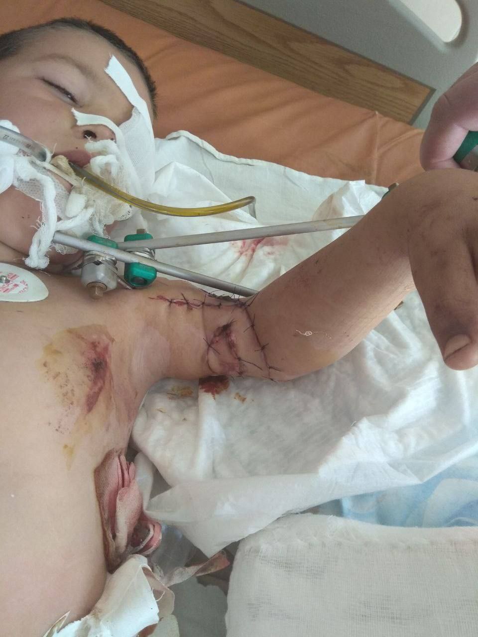 Украинские артиллеристы оторвал руку двухлетнему малышу